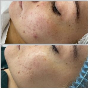 facial anti acnee before and after
